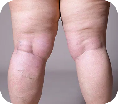 Lymphedema